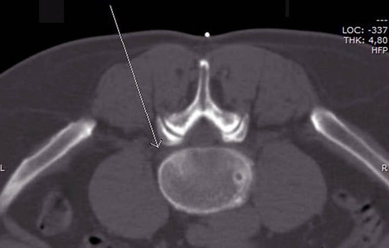 CT-Aufnahme bei einer gezielten Schmerztherapie